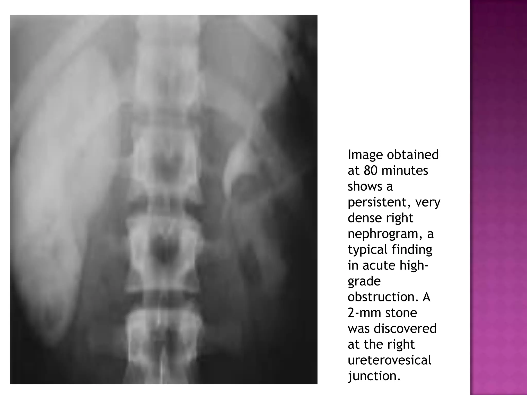 Image obtained
at 80 minutes
shows a
persistent, very
dense right
nephrogram, a
typical finding
in acute high-
grade
obstruction. A
2-mm stone
was discovered
at the right
ureterovesical
junction.
 