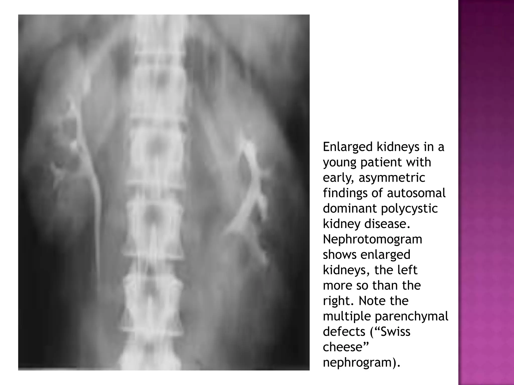 Enlarged kidneys in a
young patient with
early, asymmetric
findings of autosomal
dominant polycystic
kidney disease.
Nephrotomogram
shows enlarged
kidneys, the left
more so than the
right. Note the
multiple parenchymal
defects (“Swiss
cheese”
nephrogram).
 