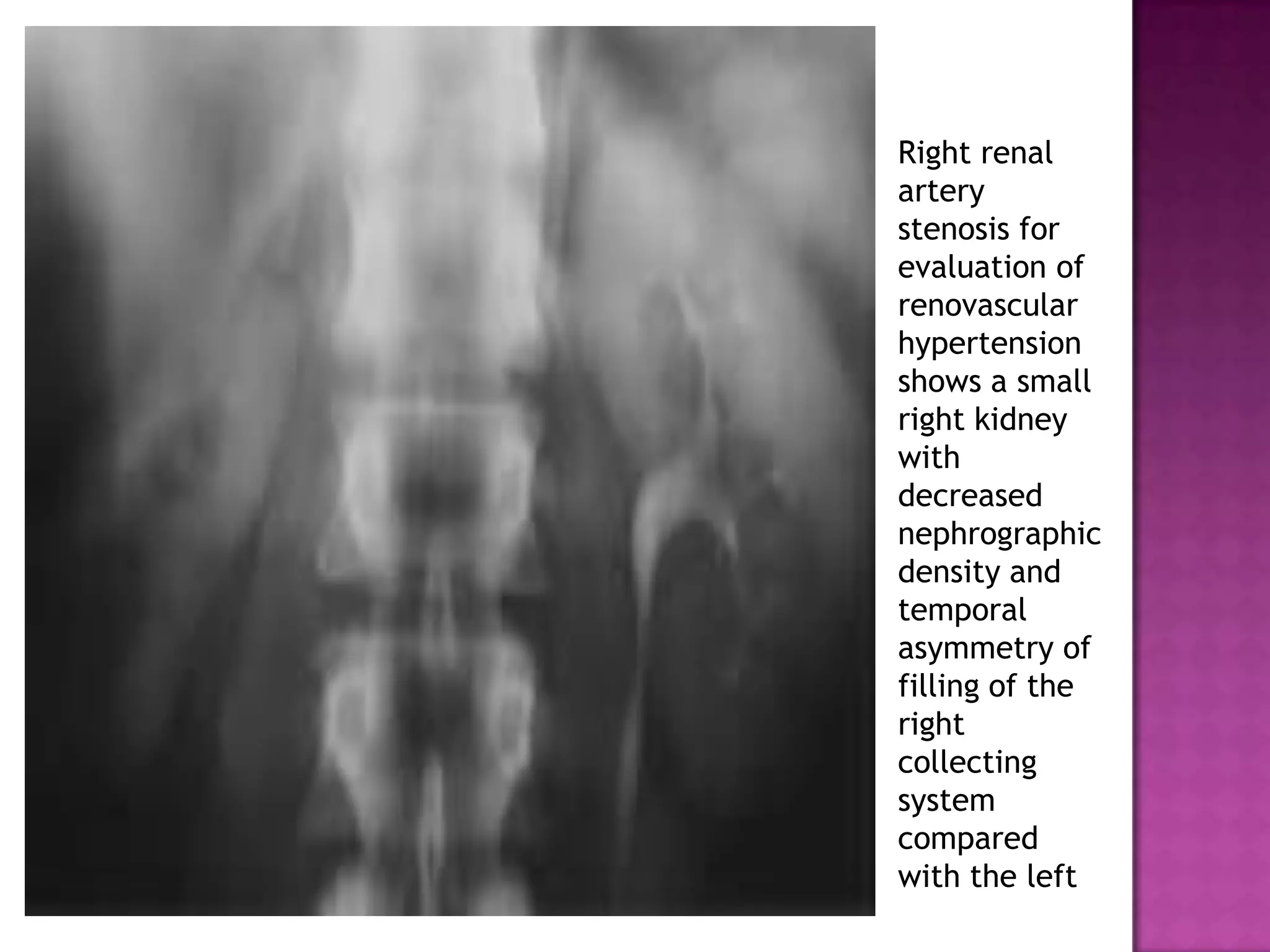 Right renal
artery
stenosis for
evaluation of
renovascular
hypertension
shows a small
right kidney
with
decreased
nephrographic
density and
temporal
asymmetry of
filling of the
right
collecting
system
compared
with the left
 