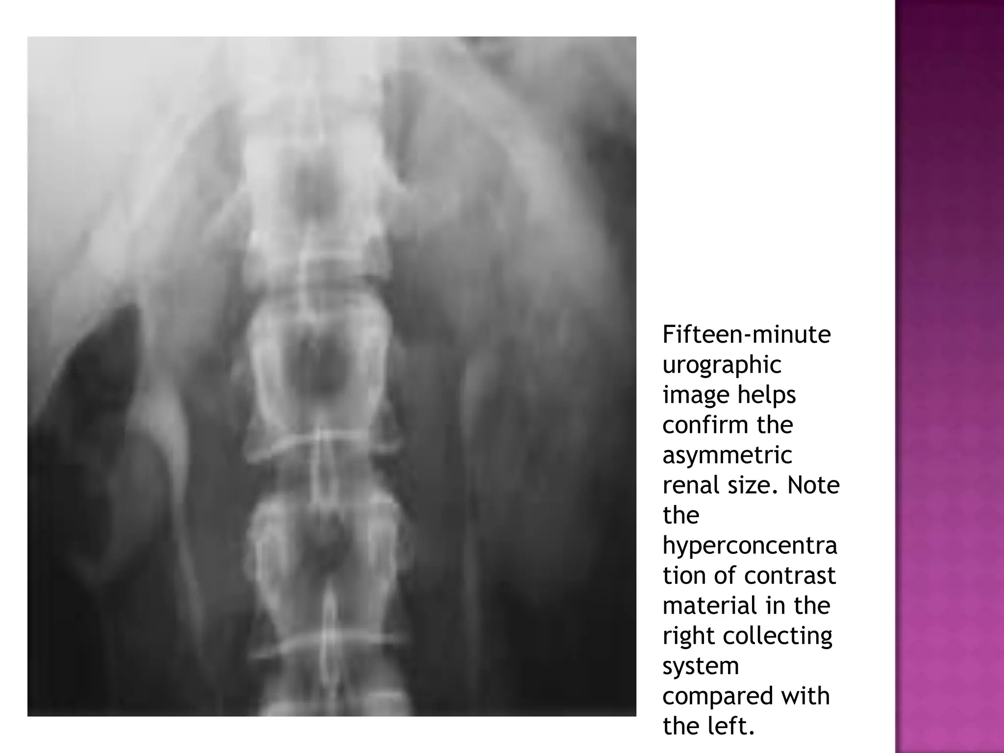Fifteen-minute
urographic
image helps
confirm the
asymmetric
renal size. Note
the
hyperconcentra
tion of contrast
material in the
right collecting
system
compared with
the left.
 