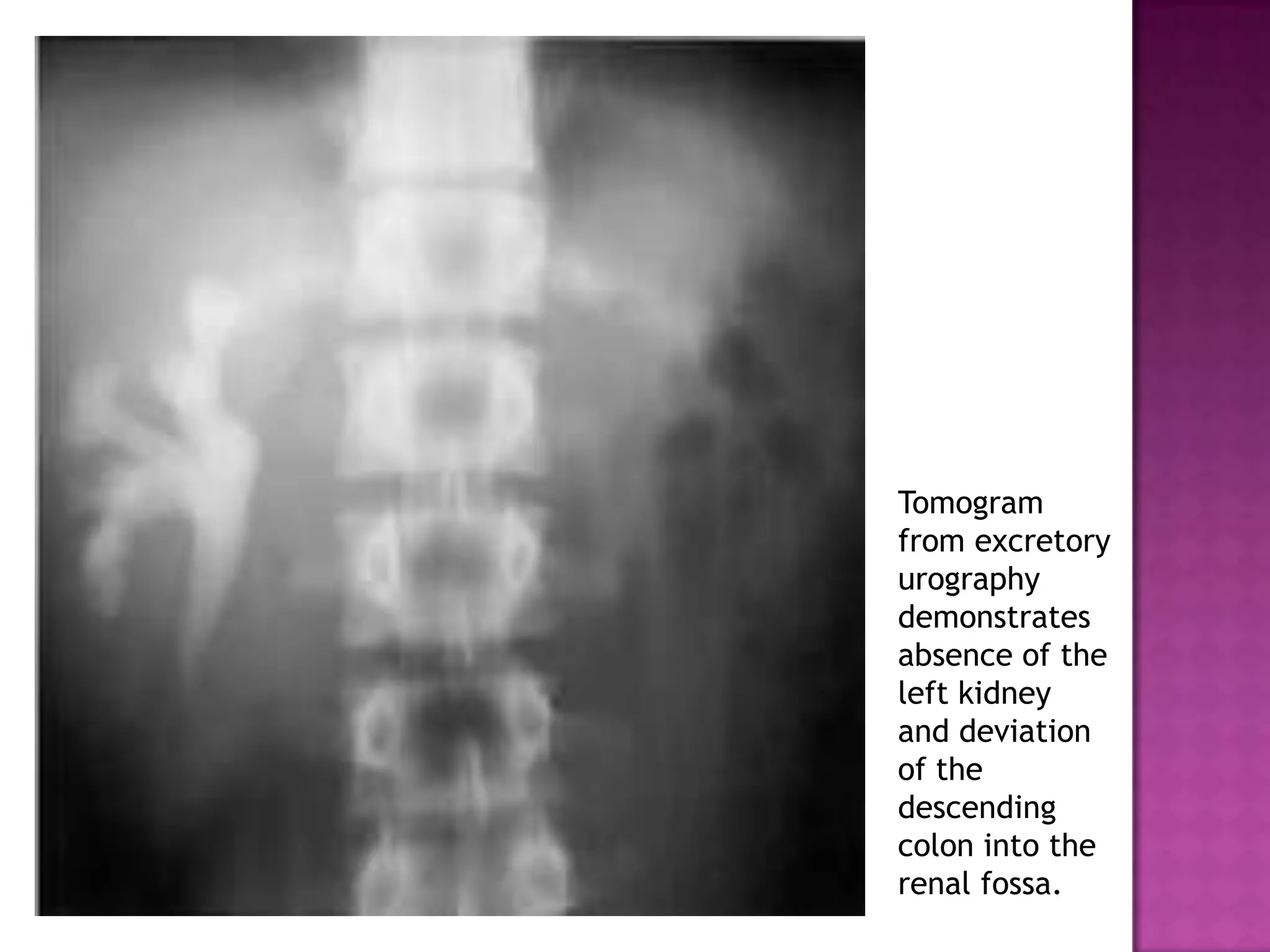Tomogram
from excretory
urography
demonstrates
absence of the
left kidney
and deviation
of the
descending
colon into the
renal fossa.
 