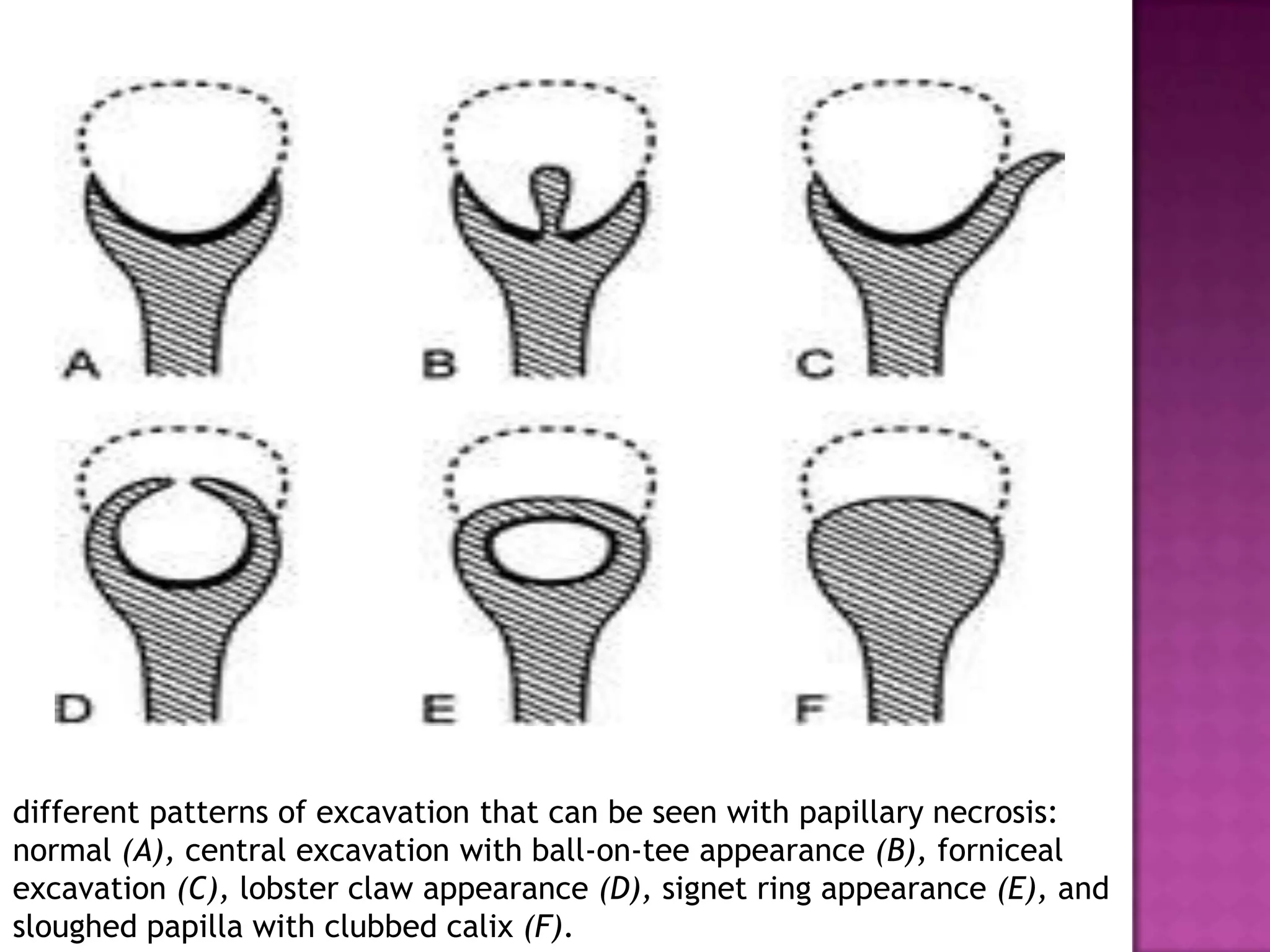 different patterns of excavation that can be seen with papillary necrosis:
normal (A), central excavation with ball-on-tee appearance (B), forniceal
excavation (C), lobster claw appearance (D), signet ring appearance (E), and
sloughed papilla with clubbed calix (F).
 