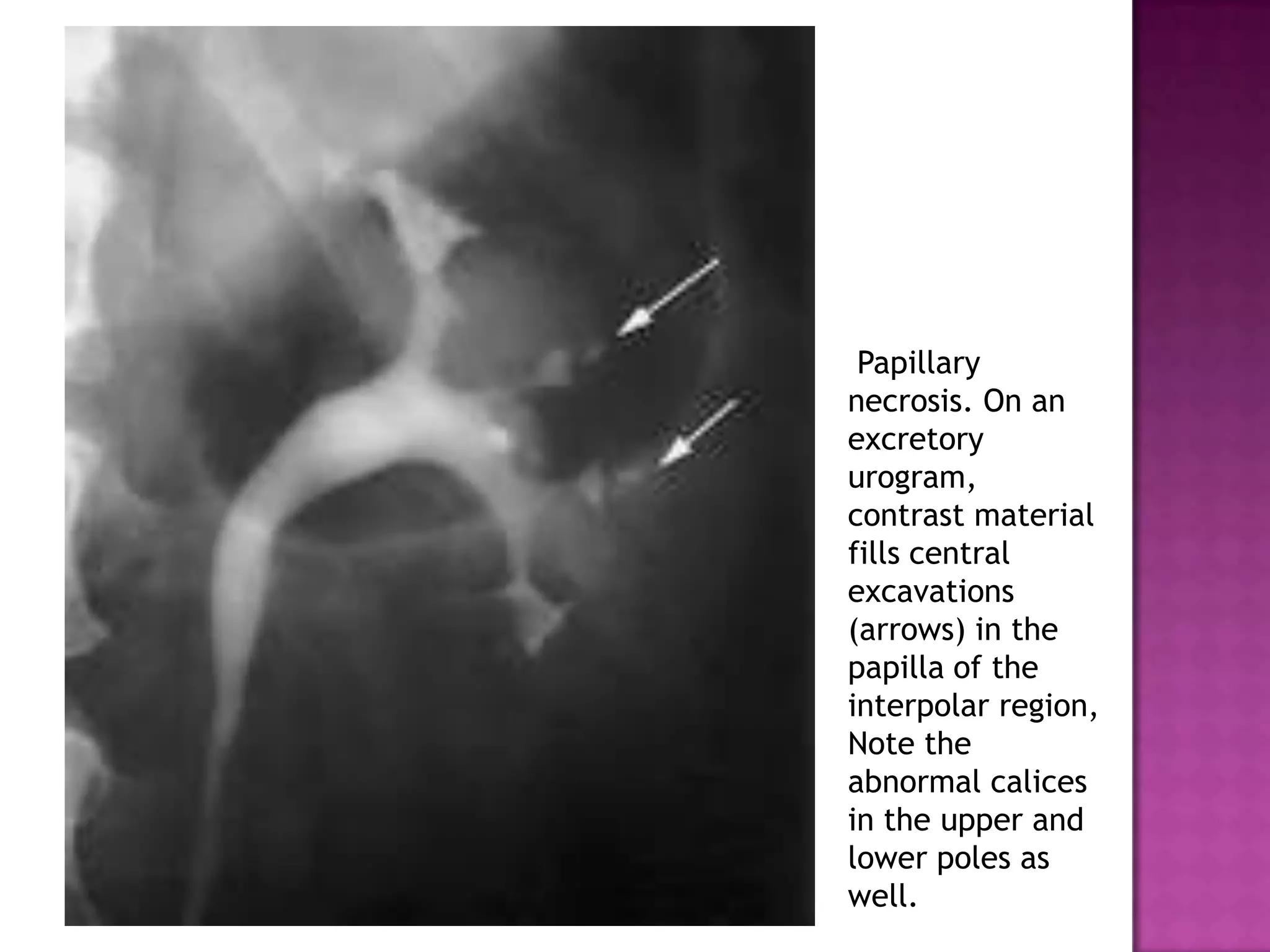 Papillary
necrosis. On an
excretory
urogram,
contrast material
fills central
excavations
(arrows) in the
papilla of the
interpolar region,
Note the
abnormal calices
in the upper and
lower poles as
well.
 