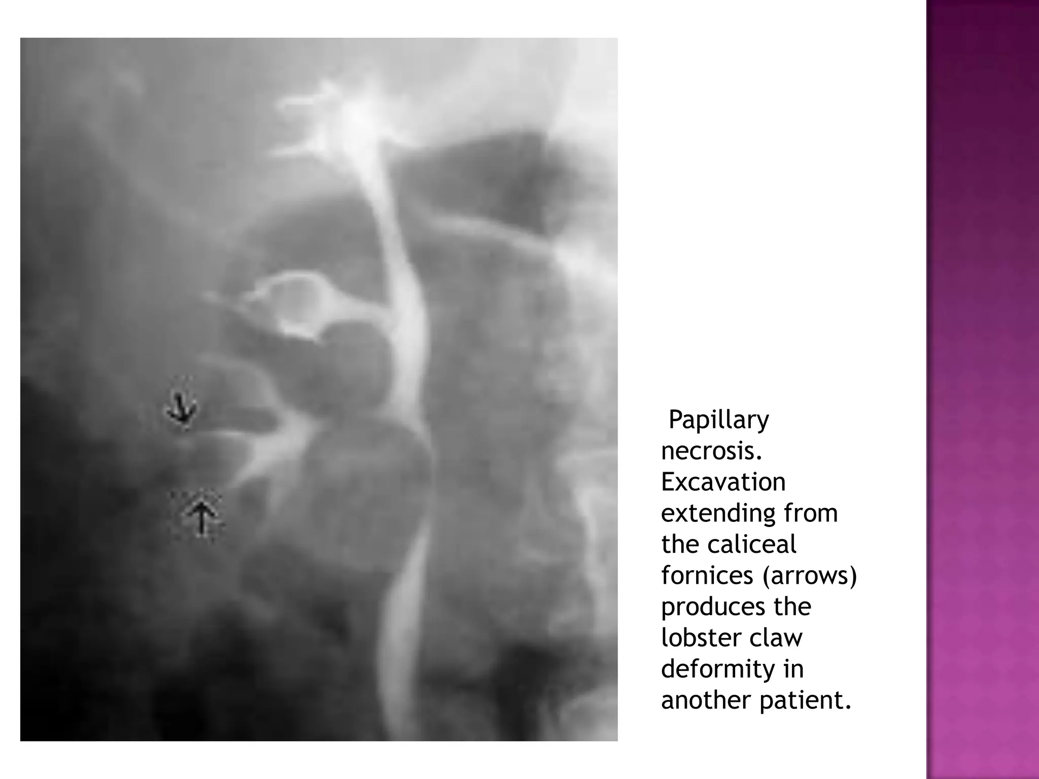 Papillary
necrosis.
Excavation
extending from
the caliceal
fornices (arrows)
produces the
lobster claw
deformity in
another patient.
 