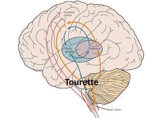 ADHD OCD 
Tourette 
 