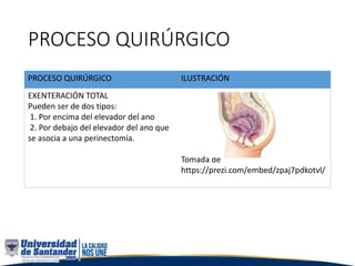 PROCESO QUIRÚRGICO
PROCESO QUIRÚRGICO ILUSTRACIÓN
EXENTERACIÓN TOTAL
Pueden ser de dos tipos:
1. Por encima del elevador del ano
2. Por debajo del elevador del ano que
se asocia a una perinectomía.
Tomada de
https://prezi.com/embed/zpaj7pdkotvl/
 