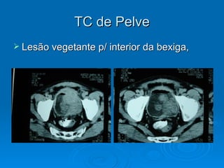 TC de Pelve Lesão vegetante p/ interior da bexiga, 