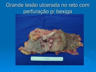 Grande lesão ulcerada no reto com perfuração p/ bexiga 