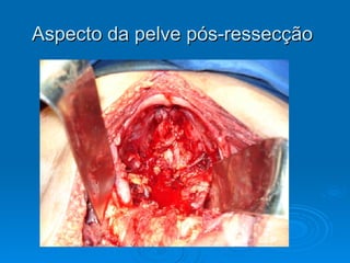 Aspecto da pelve pós-ressecção  