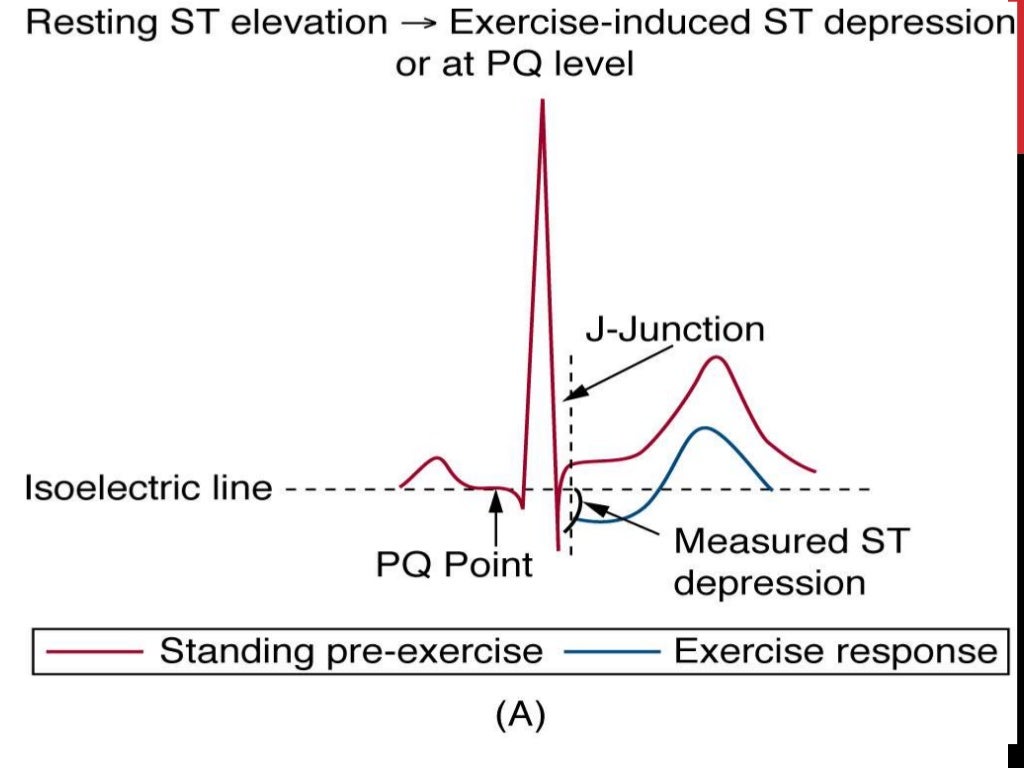 Exercise ecg