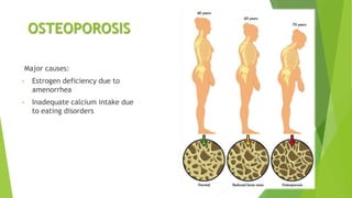 OSTEOPOROSIS
Major causes:
• Estrogen deficiency due to
amenorrhea
• Inadequate calcium intake due
to eating disorders
 