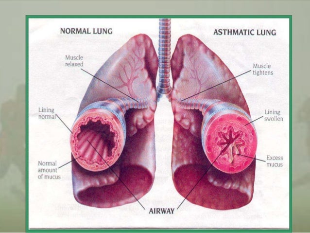 Exercise induced asthma &bronchospasm