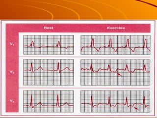 Exercise stress ecg. dmo | PPT