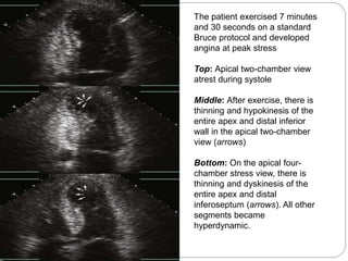 The patient exercised 7 minutes
and 30 seconds on a standard
Bruce protocol and developed
angina at peak stress
Top: Apical two-chamber view
atrest during systole
Middle: After exercise, there is
thinning and hypokinesis of the
entire apex and distal inferior
wall in the apical two-chamber
view (arrows)
Bottom: On the apical four-
chamber stress view, there is
thinning and dyskinesis of the
entire apex and distal
inferoseptum (arrows). All other
segments became
hyperdynamic.
 