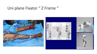 Principles External Fixator ROLE OF EXTERNAL FIXATOR IN OPEN FRACTURE.pptx