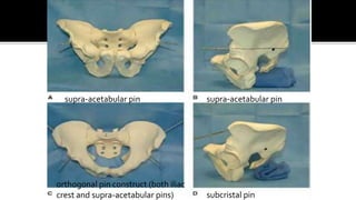 supra-acetabular pin supra-acetabular pin
orthogonal pin construct (both iliac
crest and supra-acetabular pins) subcristal pin
 