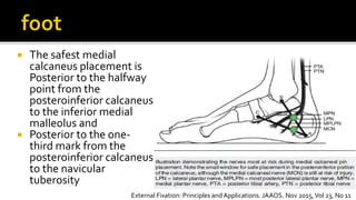  The safest medial
calcaneus placement is
Posterior to the halfway
point from the
posteroinferior calcaneus
to the inferior medial
malleolus and
 Posterior to the one-
third mark from the
posteroinferior calcaneus
to the navicular
tuberosity
External Fixation: Principles andApplications. JAAOS. Nov 2015,Vol 23, No 11
 