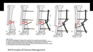AO Principles of Fracture Management
 