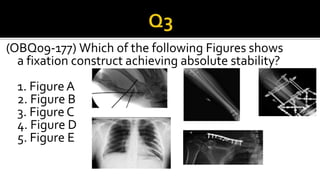 (OBQ09-177) Which of the following Figures shows
a fixation construct achieving absolute stability?
1. FigureA
2. Figure B
3. Figure C
4. Figure D
5. Figure E
 