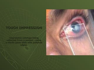 TOUCH IMPRESSION
TOUCH IMPRESSION
Impression cytology being
Impression cytology being
collected From a patient , using
collected From a patient , using
a sterile glass slide with polished
a sterile glass slide with polished
edges.
edges.
 