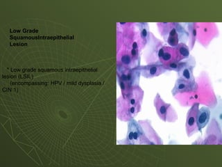 * Low grade squamous intraepithelial
lesion (LSIL)
(encompassing: HPV / mild dysplasia /
CIN 1)
Low Grade
SquamousIntraepithelial
Lesion
 
