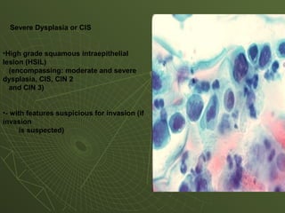 •High grade squamous intraepithelial
lesion (HSIL)
(encompassing: moderate and severe
dysplasia, CIS, CIN 2
and CIN 3)
•- with features suspicious for invasion (if
invasion
is suspected)
Severe Dysplasia or CIS
 