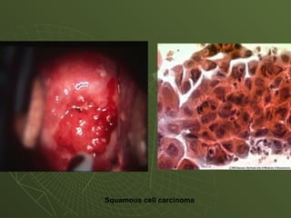 * Squamous cell carcinoma
 