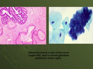 Adenocarcinoma in situ of the cervix
(upper left), next to normal glandular
epithelium (lower right).
 