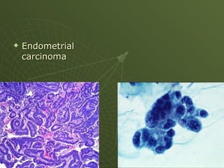  Endometrial
Endometrial
carcinoma
carcinoma
 