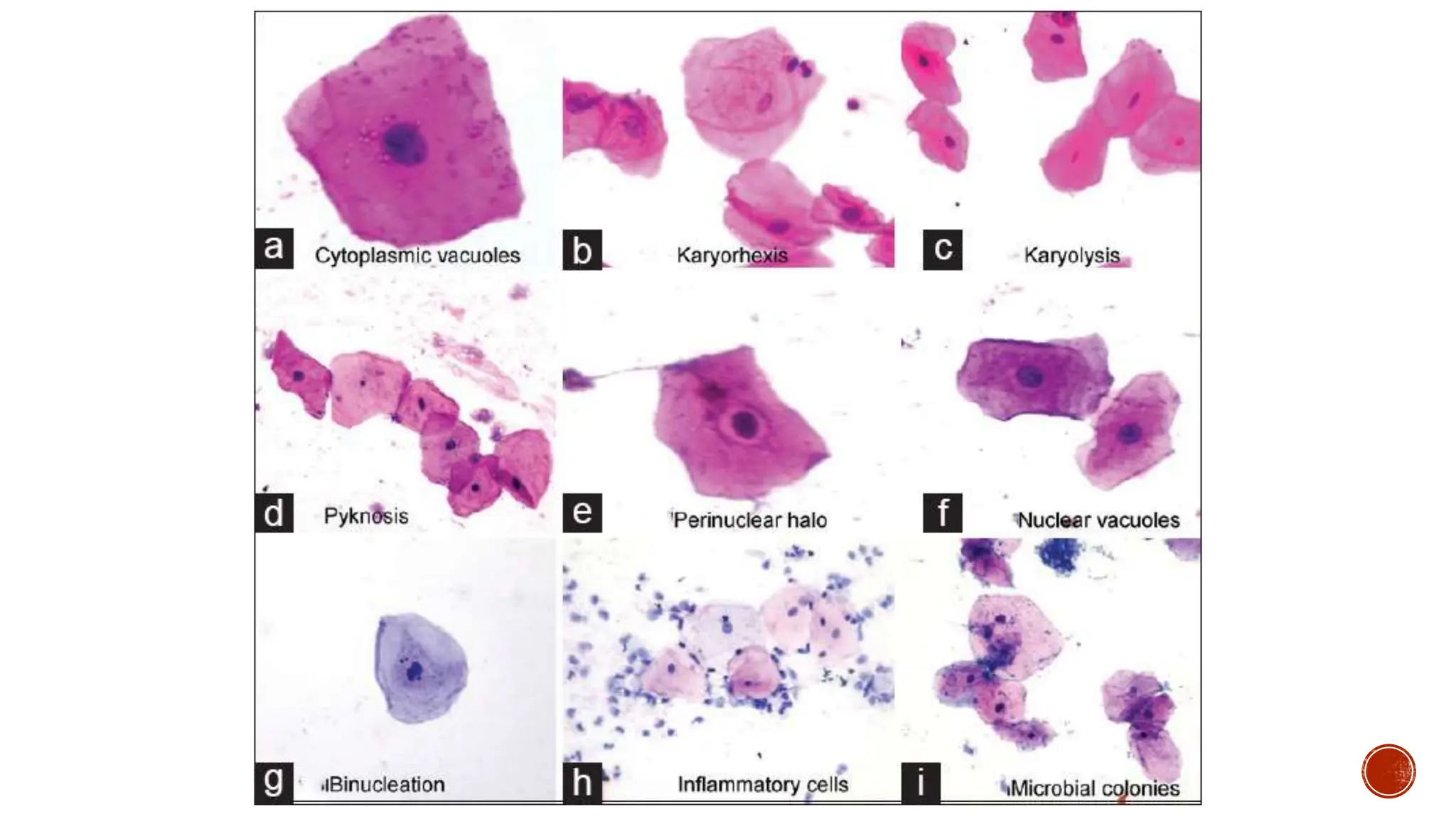 EXFOLIATIVE CYTOLOGY ORAL CYTOSMEAR ORAL CYTOLOGY PPTX EXFOLIATIVE CYTOLOGY ORAL CYTOSMEAR ORAL CYTOLOGY PPTX