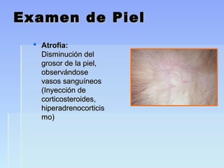 Examen de PielExamen de Piel
 Atrofia:Atrofia:
Disminución delDisminución del
grosor de la piel,grosor de la piel,
observándoseobservándose
vasos sanguíneosvasos sanguíneos
(Inyección de(Inyección de
corticosteroides,corticosteroides,
hiperadrenocorticishiperadrenocorticis
mo)mo)
 