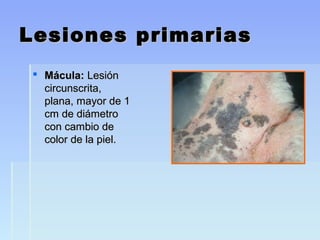 Lesiones primariasLesiones primarias
 Mácula:Mácula: LesiónLesión
circunscrita,circunscrita,
plana, mayor de 1plana, mayor de 1
cm de diámetrocm de diámetro
con cambio decon cambio de
color de la piel.color de la piel.
 
