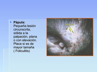  Pápula:Pápula:
Pequeña lesiónPequeña lesión
circunscrita,circunscrita,
sólida a lasólida a la
palpación, planapalpación, plana
o con elevación.o con elevación.
Placa si es dePlaca si es de
mayor tamañamayor tamaña
( Foliculitis)( Foliculitis)
 