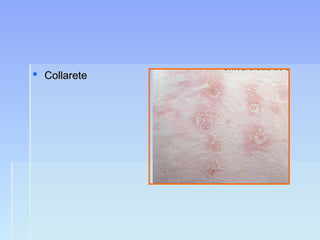  CollareteCollarete
 