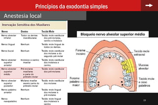 19
Princípios da exodontia simples
Anestesia local
Bloqueio nervo alveolar superior médio
 
