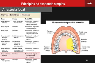 21
Princípios da exodontia simples
Anestesia local
Bloqueio nervo palatino anterior
 
