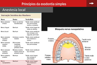 22
Princípios da exodontia simples
Anestesia local
Bloqueio nervo nasopalatino
 