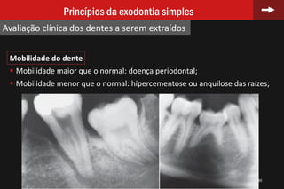 Mobilidade do dente
 Mobilidade maior que o normal: doença periodontal;
 Mobilidade menor que o normal: hipercementose ou anquilose das raízes;
40
Princípios da exodontia simples
Avaliação clínica dos dentes a serem extraídos
 