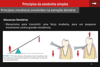 Alavancas Dentárias
 Mecanismo para transmitir uma força modesta, para um pequeno
movimento contra grande resistência;
Fig. 7.36
Fig. 7.37
46
Princípios da exodontia simples
Princípios mecânicos envolvidos na extração dentária
 