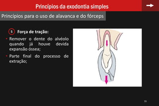Força de tração:
• Remover o dente do alvéolo
quando já houve devida
expansão óssea;
• Parte final do processo de
extração;
55
Princípios da exodontia simples
Princípios para o uso de alavanca e do fórceps
5
 