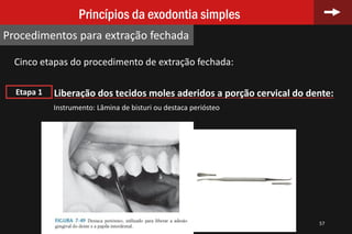 Cinco etapas do procedimento de extração fechada:
Liberação dos tecidos moles aderidos a porção cervical do dente:
57
Princípios da exodontia simples
Procedimentos para extração fechada
Etapa 1
Instrumento: Lâmina de bisturi ou destaca periósteo
 