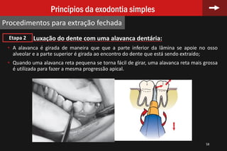 Luxação do dente com uma alavanca dentária:
• A alavanca é girada de maneira que que a parte inferior da lâmina se apoie no osso
alveolar e a parte superior é girada ao encontro do dente que está sendo extraído;
• Quando uma alavanca reta pequena se torna fácil de girar, uma alavanca reta mais grossa
é utilizada para fazer a mesma progressão apical.
58
Princípios da exodontia simples
Procedimentos para extração fechada
Etapa 2
 