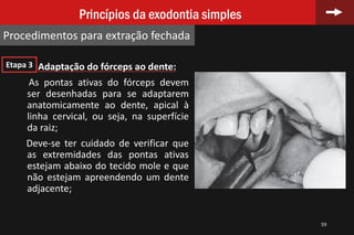 59
Princípios da exodontia simples
Procedimentos para extração fechada
Adaptação do fórceps ao dente:
As pontas ativas do fórceps devem
ser desenhadas para se adaptarem
anatomicamente ao dente, apical à
linha cervical, ou seja, na superfície
da raiz;
Deve-se ter cuidado de verificar que
as extremidades das pontas ativas
estejam abaixo do tecido mole e que
não estejam apreendendo um dente
adjacente;
Etapa 3
 