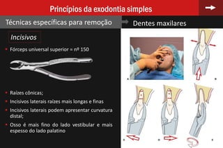 67
Princípios da exodontia simples
Técnicas específicas para remoção Dentes maxilares
 Fórceps universal superior = nº 150
 Raízes cônicas;
 Incisivos laterais raízes mais longas e finas
 Incisivos laterais podem apresentar curvatura
distal;
 Osso é mais fino do lado vestibular e mais
espesso do lado palatino
Incisivos
 