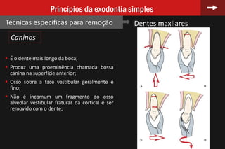 69
Princípios da exodontia simples
Técnicas específicas para remoção Dentes maxilares
 É o dente mais longo da boca;
 Produz uma proeminência chamada bossa
canina na superfície anterior;
 Osso sobre a face vestibular geralmente é
fino;
 Não é incomum um fragmento do osso
alveolar vestibular fraturar da cortical e ser
removido com o dente;
Caninos
 