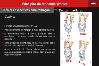 70
Princípios da exodontia simples
Técnicas específicas para remoção Dentes maxilares
 Fórceps universal superior nº150
 Posicionamento do fórceps o mais apical possível;
 O movimento inicial é apical e então para a
vestibular, com uma pressão de retorno para a
palatina;
 Uma pequena quantidade força rotacional pode
ser útil para expandir o alvéolo dentário;
 Após a luxação do dente ele é removido do
alvéolo na direção vestíbulo-incisal com a força de
tração vestibular
Caninos
 