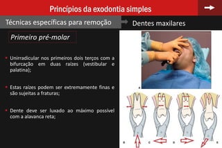72
Princípios da exodontia simples
Técnicas específicas para remoção Dentes maxilares
Primeiro pré-molar
 Unirradicular nos primeiros dois terços com a
bifurcação em duas raízes (vestibular e
palatina);
 Estas raízes podem ser extremamente finas e
são sujeitas a fraturas;
 Dente deve ser luxado ao máximo possível
com a alavanca reta;
 