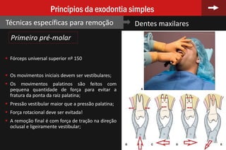 73
Princípios da exodontia simples
Técnicas específicas para remoção Dentes maxilares
Primeiro pré-molar
 Fórceps universal superior nº 150
 Os movimentos iniciais devem ser vestibulares;
 Os movimentos palatinos são feitos com
pequena quantidade de força para evitar a
fratura da ponta da raiz palatina;
 Pressão vestibular maior que a pressão palatina;
 Força rotacional deve ser evitada!
 A remoção final é com força de tração na direção
oclusal e ligeiramente vestibular;
 