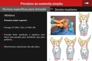 76
Princípios da exodontia simples
Técnicas específicas para remoção Dentes maxilares
Molares
Primeiro molar superior:
 Fórceps nº 53R e 53L / nº 89 e 90
 Pressão forte vestibular e palatina com
força mais pesada para vestibular que para
palatina;
 Movimentos rotacionais não são úteis;
 