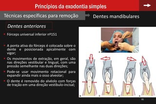 81
Princípios da exodontia simples
Técnicas específicas para remoção Dentes mandibulares
 Fórceps universal inferior nº151
 A ponta ativa do fórceps é colocada sobre o
dente e posicionada apicalmente com
vigor;
 Os movimentos de extração, em geral, são
nas direções vestibular e lingual, com uma
pressão semelhante nas duas direções;
 Pode-se usar movimento rotacional para
expandir ainda mais o osso alveolar;
 O dente é removido do alvéolo com forças
de tração em uma direção vestíbulo-incisal;
Dentes anteriores
 
